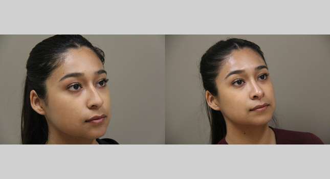Nose Surgery: Image #1323