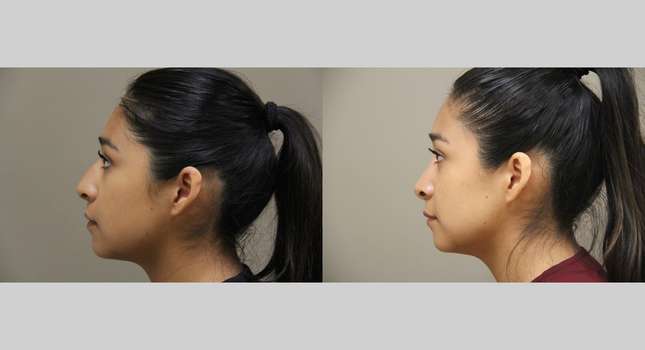 Nose Surgery: Image #1324