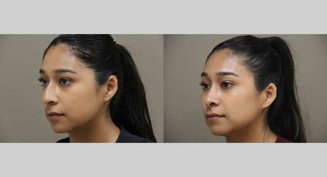 Nose Surgery: Image #1325