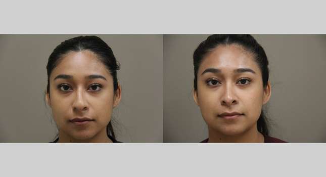 Nose Surgery: Image #1326