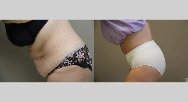 Body Lift: Image #1327