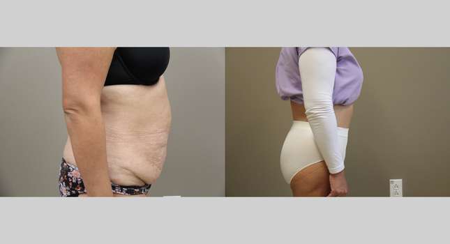 Body Lift: Image #1328