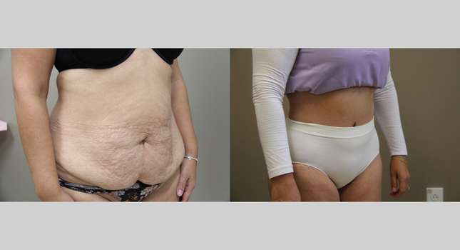 Body Lift: Image #1329