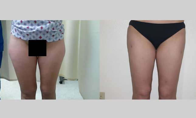 Liposuction: Image #133