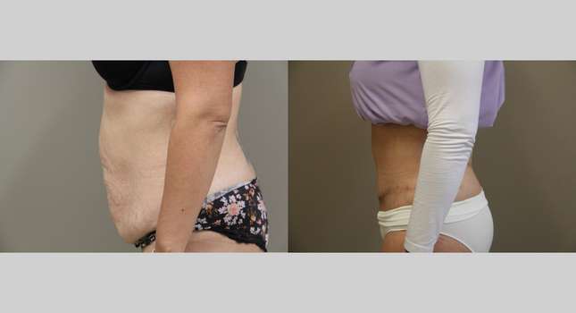 Body Lift: Image #1330