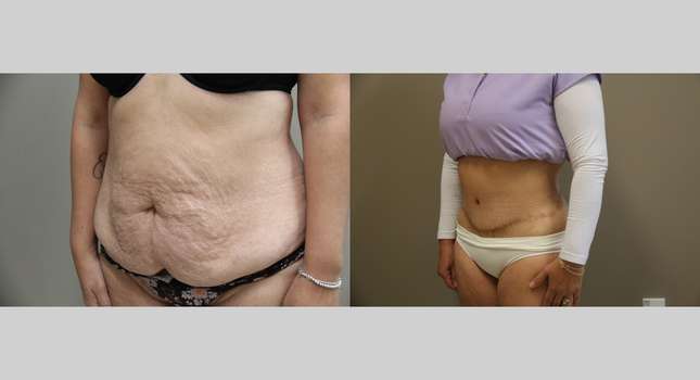 Body Lift: Image #1331