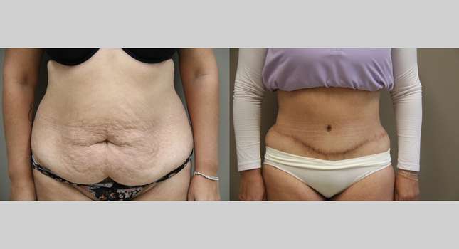 Body Lift: Image #1332
