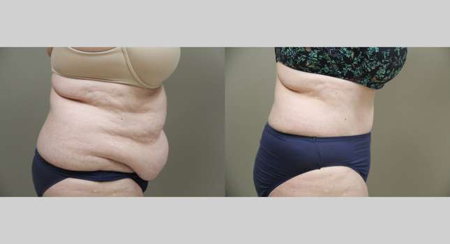 Tummy Tuck: Image #1334