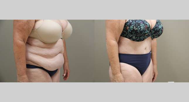 Tummy Tuck: Image #1335