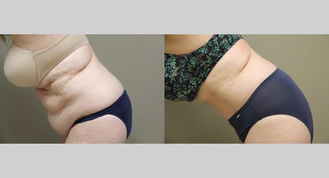 Tummy Tuck: Image #1336