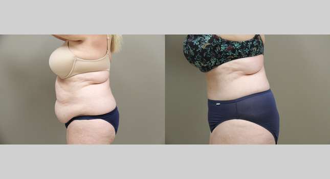Tummy Tuck: Image #1337