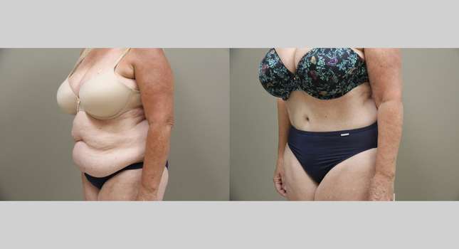 Tummy Tuck: Image #1338