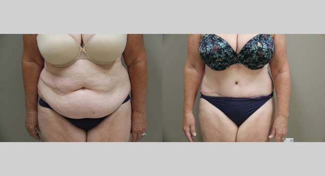 Tummy Tuck: Image #1339