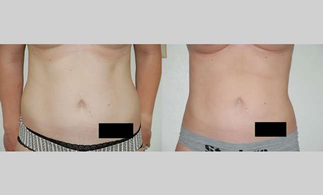 Liposuction: Image #134