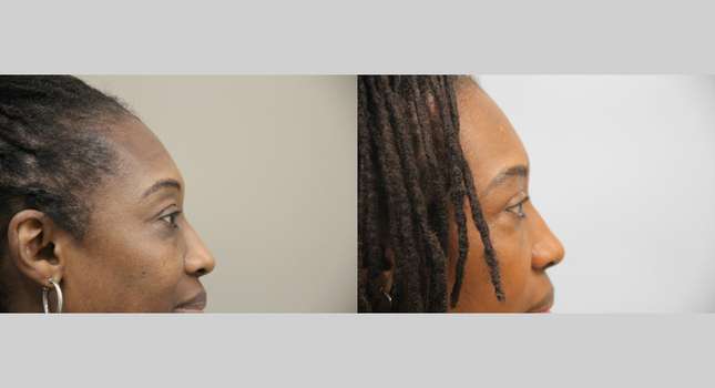 Eyelid Surgery: Image #1347