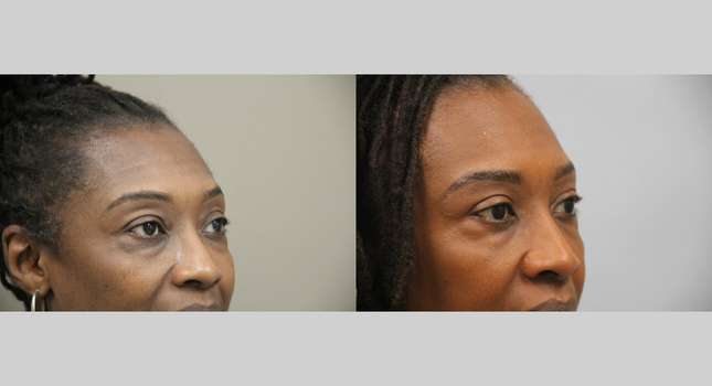 Eyelid Surgery: Image #1348