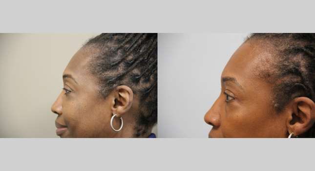 Eyelid Surgery: Image #1349