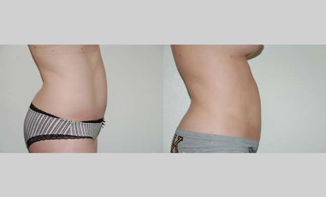 Liposuction: Image #135