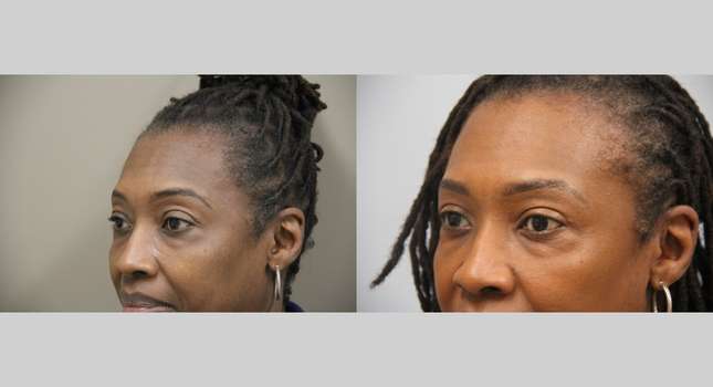 Eyelid Surgery: Image #1350