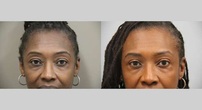 Eyelid Surgery: Image #1351