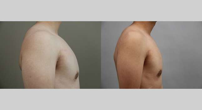 Breast Reconstruction: Image #1352