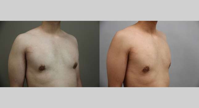 Breast Reconstruction: Image #1353