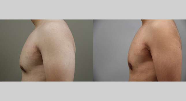 Breast Reconstruction: Image #1354
