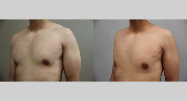 Breast Reconstruction: Image #1355