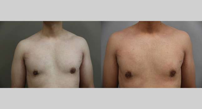 Breast Reconstruction: Image #1356