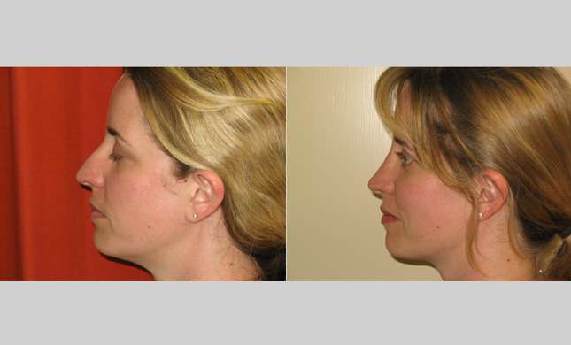 Nose Surgery: Image #136