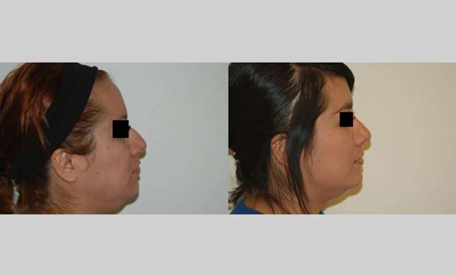 Nose Surgery: Image #137