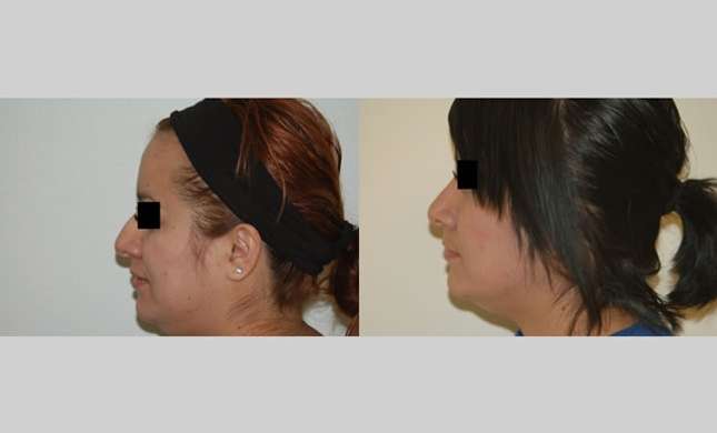 Nose Surgery: Image #138