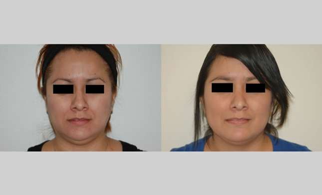 Nose Surgery: Image #139