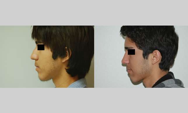 Nose Surgery: Image #140
