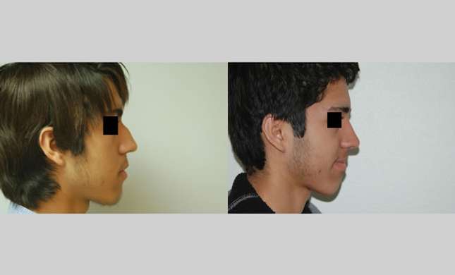 Nose Surgery: Image #142