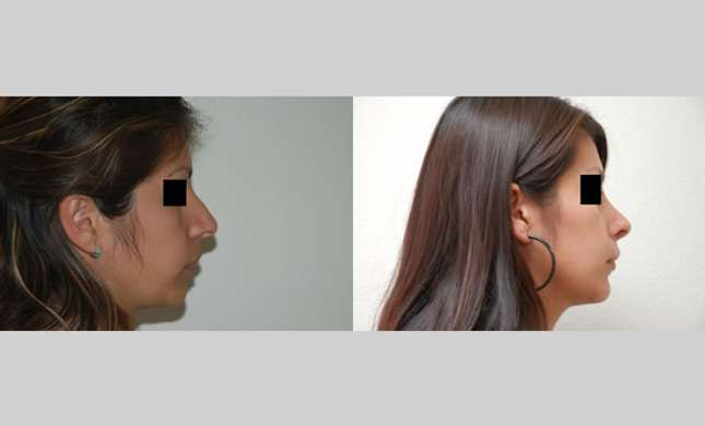 Nose Surgery: Image #143