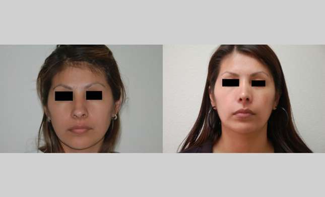 Nose Surgery: Image #144