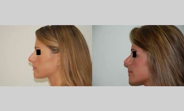 Nose Surgery: Image #145