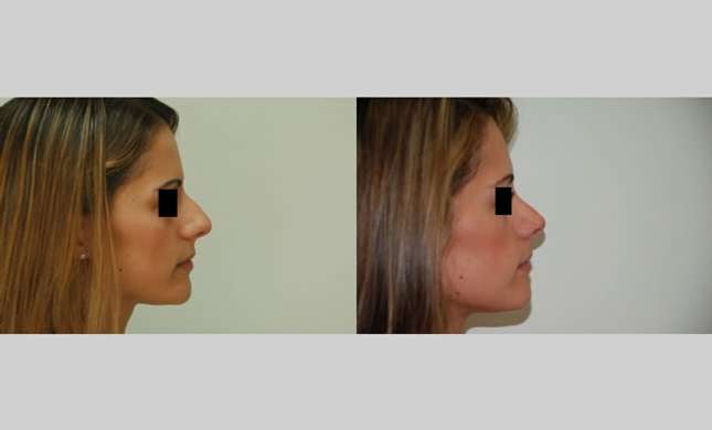 Nose Surgery: Image #146