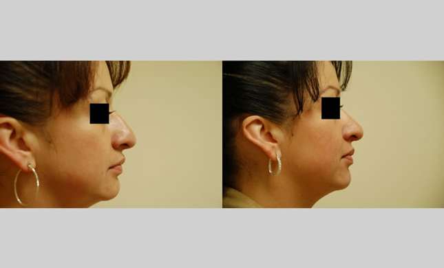 Nose Surgery: Image #147