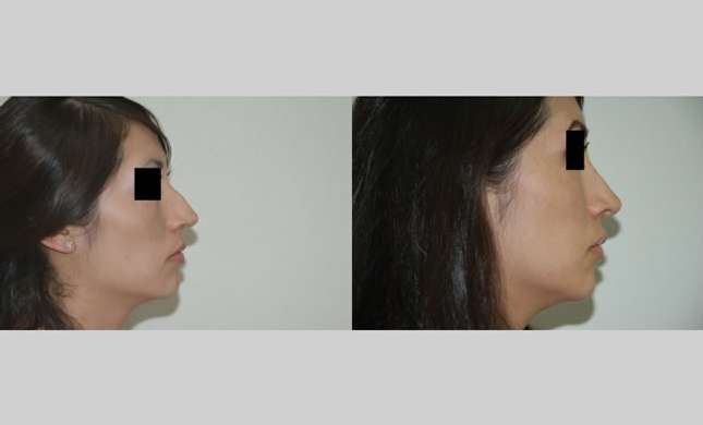Nose Surgery: Image #148