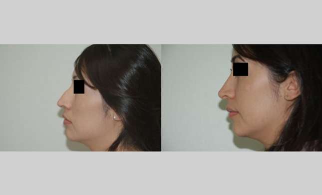 Nose Surgery: Image #149