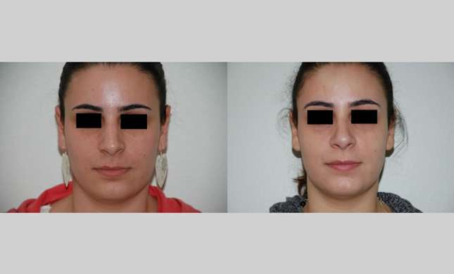 Nose Surgery: Image #150