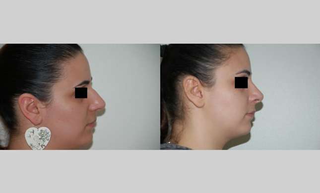 Nose Surgery: Image #151