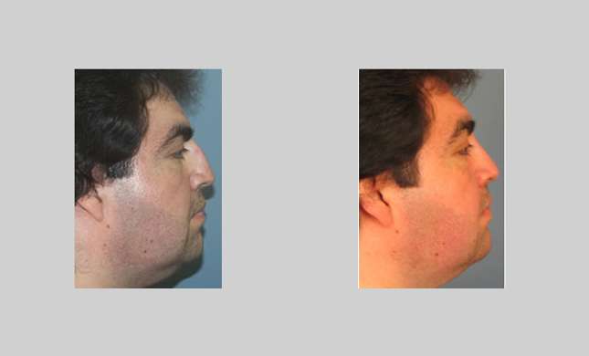 Nose Surgery: Image #152