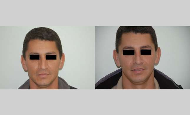 Nose Surgery: Image #153