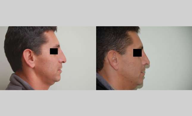 Nose Surgery: Image #154