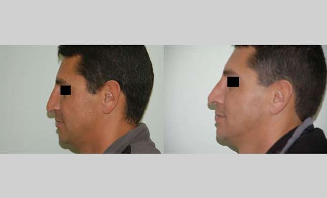 Nose Surgery: Image #155