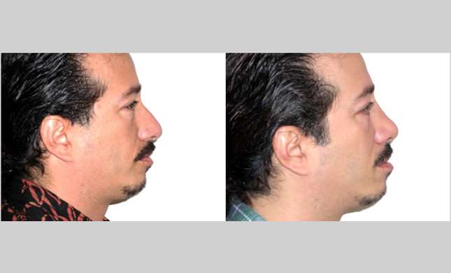 Nose Surgery: Image #156