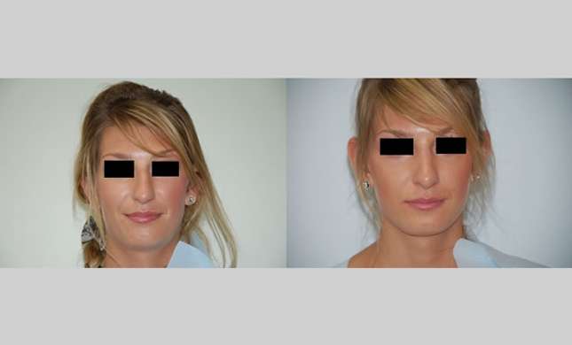 Nose Surgery: Image #157